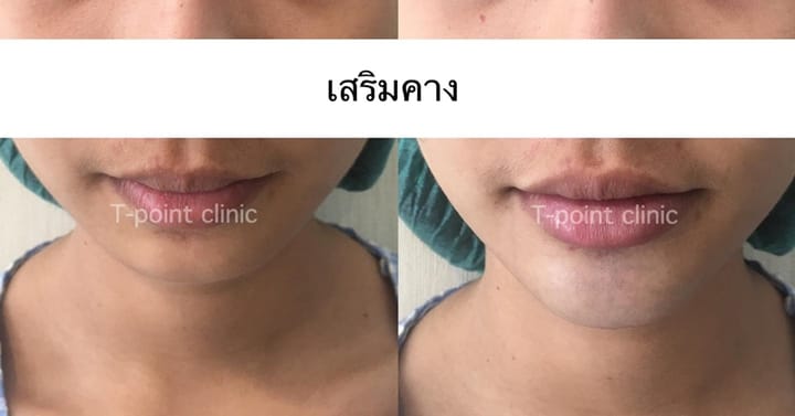 ก่อนเสริมคางเชียงใหม่ ต้องรู้อะไรอีกมากมาย