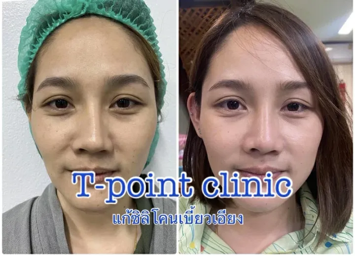 แก้จมูก เชียงใหม่ เลือกคลินิกดีๆ รับรองไม่เจอปัญหา